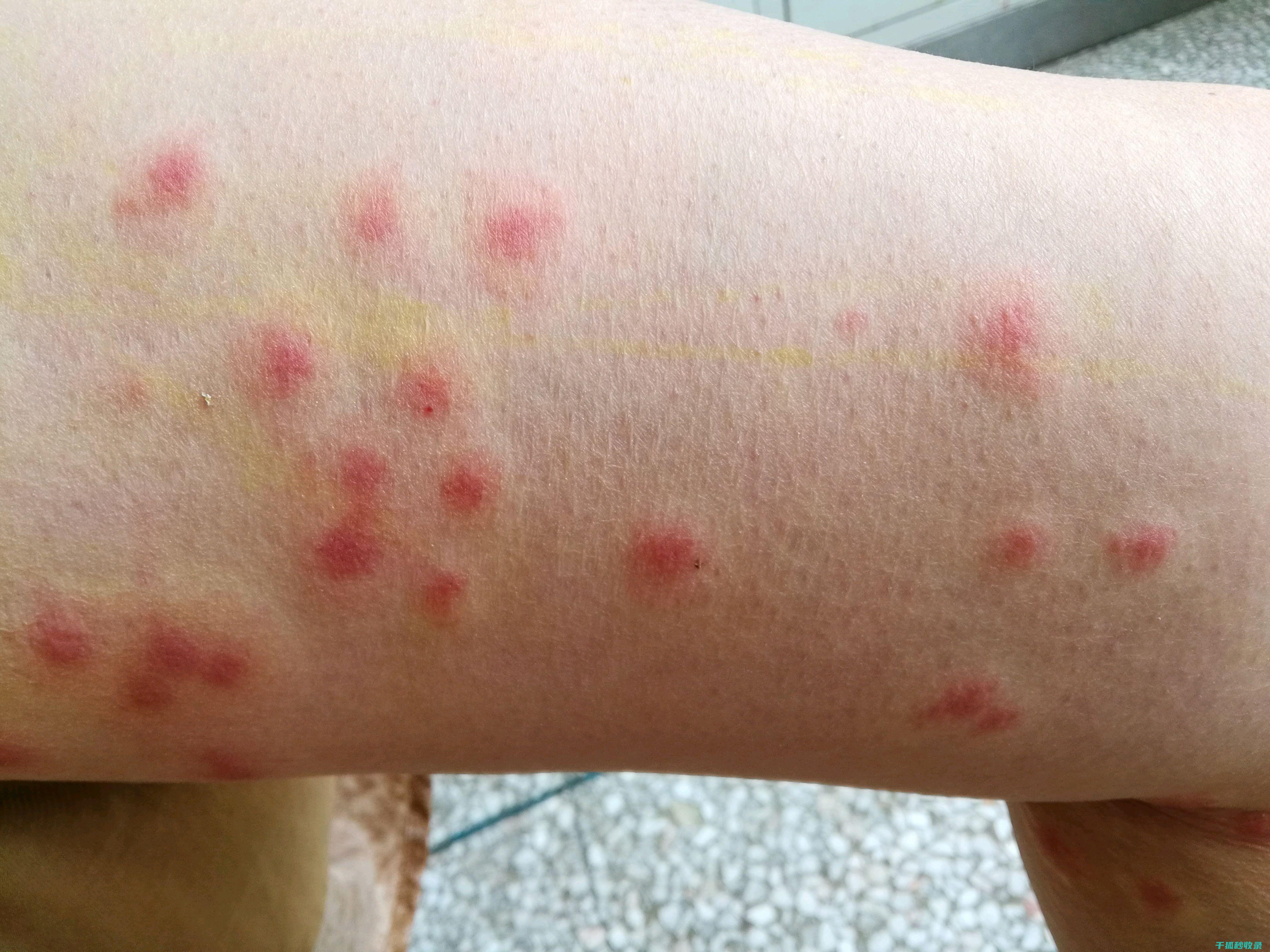 蚊虫叮咬后的止痒攻略，轻松应对瘙痒问题 (蚊虫叮咬后的黑印子怎么去除)